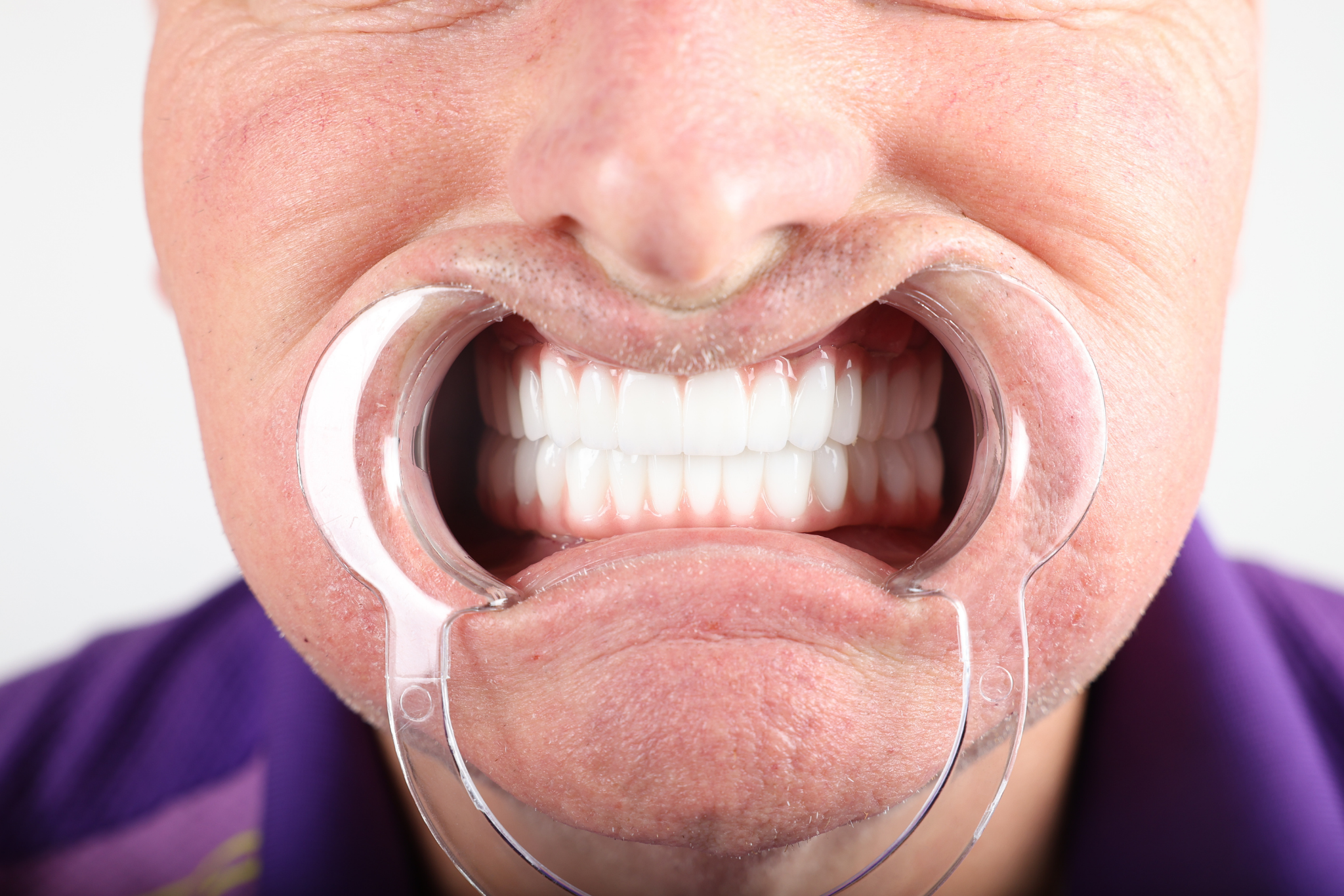 After All-on-6 Implant Treatment